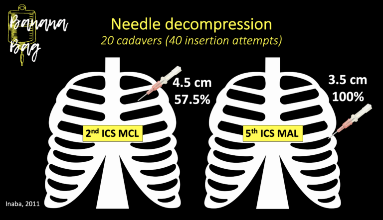 Needle Decompression